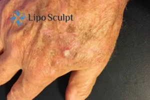 Best Actinic Keratoses Removal 2 Improve your wellbeing and health with Actinic Keratoses Salisbury removal.treatment