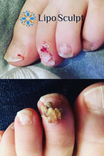 Wart removal customer results from Lipo Sculpt Salisbury
